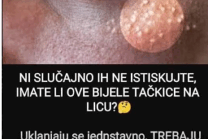 Uklanjaju se jednstavno, TREBAJU VAM 3 SASTOJKA KOJA IMATE U KUĆI – NI SLUČAJNO IH NE ISTISKUJTE,AKO IMATE OVE BIJELE TAČKICE NA LICU!