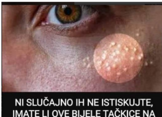 Uklanjaju se jednstavno, TREBAJU VAM 3 SASTOJKA KOJA IMATE U KUĆI – NI SLUČAJNO IH NE ISTISKUJTE,AKO IMATE OVE BIJELE TAČKICE NA LICU! Uklanjaju se jednstavno, TREBAJU VAM 3 SASTOJKA KOJA IMATE U KUĆI – NI SLUČAJNO IH NE ISTISKUJTE,AKO IMATE OVE BIJELE TAČKICE NA LICU!