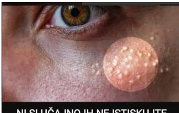 Uklanjaju se jednstavno, TREBAJU VAM 3 SASTOJKA KOJA IMATE U KUĆI – NI SLUČAJNO IH NE ISTISKUJTE,AKO IMATE OVE BIJELE TAČKICE NA LICU! Uklanjaju se jednstavno, TREBAJU VAM 3 SASTOJKA KOJA IMATE U KUĆI – NI SLUČAJNO IH NE ISTISKUJTE,AKO IMATE OVE BIJELE TAČKICE NA LICU!