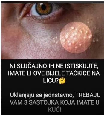 Uklanjaju se jednstavno, TREBAJU VAM 3 SASTOJKA KOJA IMATE U KUĆI – NI SLUČAJNO IH NE ISTISKUJTE,AKO IMATE OVE BIJELE TAČKICE NA LICU! Uklanjaju se jednstavno, TREBAJU VAM 3 SASTOJKA KOJA IMATE U KUĆI – NI SLUČAJNO IH NE ISTISKUJTE,AKO IMATE OVE BIJELE TAČKICE NA LICU!