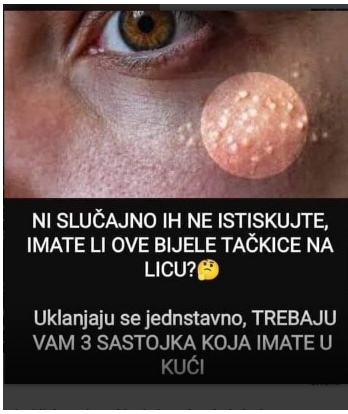 Uklanjaju se jednstavno, TREBAJU VAM 3 SASTOJKA KOJA IMATE U KUĆI – NI SLUČAJNO IH NE ISTISKUJTE,AKO IMATE OVE BIJELE TAČKICE NA LICU!