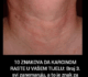 10 ZNAKOVA DA KARCINOM RASTE U VAŠEM TIJELU: Broj 3. svi zanemaruju, a to je znak za uzbunu!