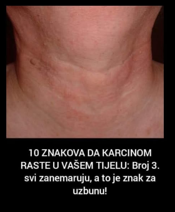 10 ZNAKOVA DA KARCINOM RASTE U VAŠEM TIJELU: Broj 3. svi zanemaruju, a to je znak za uzbunu!
