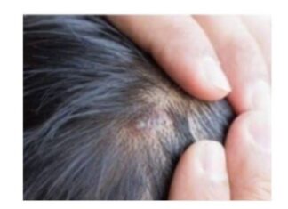 BUBULJICE NA GLAVI SU SVE ČEŠĆI PROBLEM: Ni slučajno ih ne istiskujte, evo zašto se javljaju I ŠTA TREBATE URADITI DA NESTANU BUBULJICE NA GLAVI SU SVE ČEŠĆI PROBLEM: Ni slučajno ih ne istiskujte, evo zašto se javljaju I ŠTA TREBATE URADITI DA NESTANU