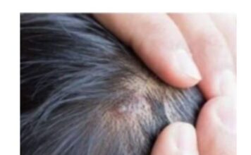 BUBULJICE NA GLAVI SU SVE ČEŠĆI PROBLEM: Ni slučajno ih ne istiskujte, evo zašto se javljaju I ŠTA TREBATE URADITI DA NESTANU BUBULJICE NA GLAVI SU SVE ČEŠĆI PROBLEM: Ni slučajno ih ne istiskujte, evo zašto se javljaju I ŠTA TREBATE URADITI DA NESTANU