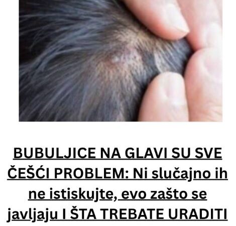 BUBULJICE NA GLAVI SU SVE ČEŠĆI PROBLEM: Ni slučajno ih ne istiskujte, evo zašto se javljaju I ŠTA TREBATE URADITI DA NESTANU