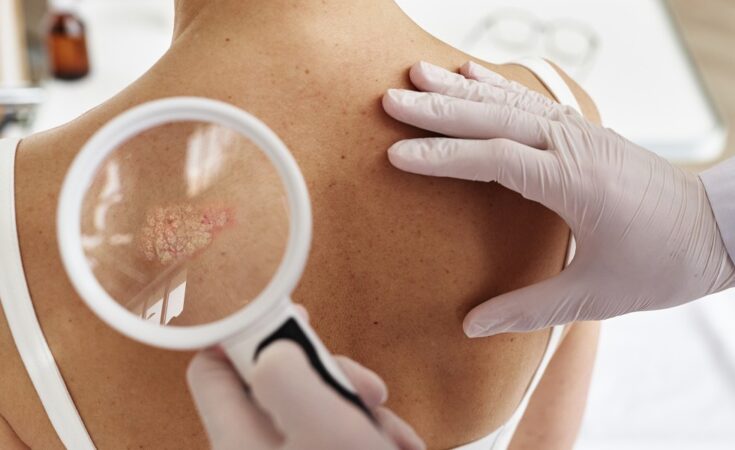 Dr. Sanja Umičević Šipka: "Biološka terapija dostupna i u BiH – novi pomak u liječenju psorijaze"