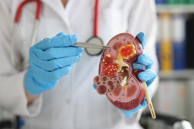 NAJČEŠĆI SIMPTOMI RA*A BUBREGA: Stručnjak upozorava na šta bi trebalo da obratite pažnju i koji su načini prevencije