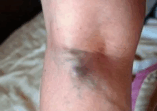NAMIRNICE KOJE POVEĆAVAJU RIZIK OD TROMBOZE, JEDNA POSEBNO: Jedemo ih svakoga dana, a štete arterijama NAMIRNICE KOJE POVEĆAVAJU RIZIK OD TROMBOZE, JEDNA POSEBNO: Jedemo ih svakoga dana, a štete arterijama