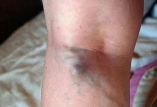 NAMIRNICE KOJE POVEĆAVAJU RIZIK OD TROMBOZE, JEDNA POSEBNO: Jedemo ih svakoga dana, a štete arterijama