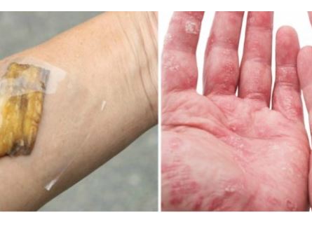 NE BACAJTE NI SLUČAJNO KORU OD OVE VOĆKE: Liječi Psorijazu, Skida Bradavice I Izbjeljuje Zube!