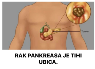 RAK PANKREASA JE TIHI UBICA. Stručnjaci upozoravaju da obratite pažnju na pet glavnih simptoma RAK PANKREASA JE TIHI UBICA. Stručnjaci upozoravaju da obratite pažnju na pet glavnih simptoma