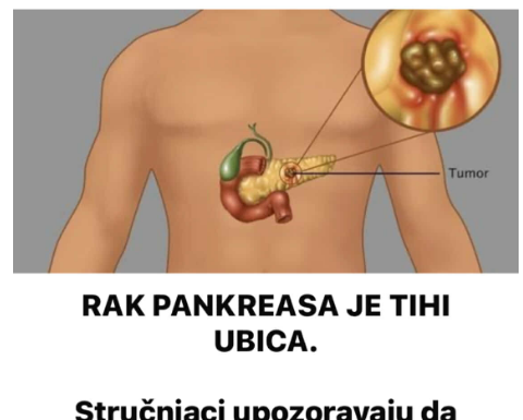 RAK PANKREASA JE TIHI UBICA. Stručnjaci upozoravaju da obratite pažnju na pet glavnih simptoma RAK PANKREASA JE TIHI UBICA. Stručnjaci upozoravaju da obratite pažnju na pet glavnih simptoma