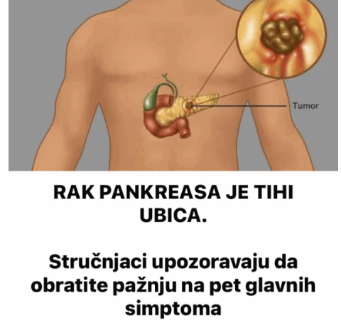 RAK PANKREASA JE TIHI UBICA. Stručnjaci upozoravaju da obratite pažnju na pet glavnih simptoma