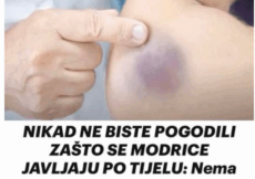 Zašto se modrice pojavljuju bez vidljivog uzroka Evo šta stručnjaci kažu