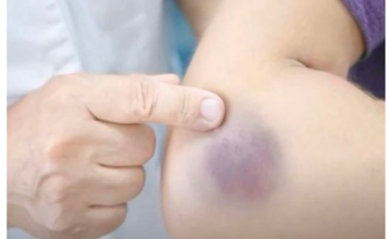 Zašto se modrice pojavljuju bez vidljivog uzroka Evo šta stručnjaci kažu Zašto se modrice pojavljuju bez vidljivog uzroka Evo šta stručnjaci kažu