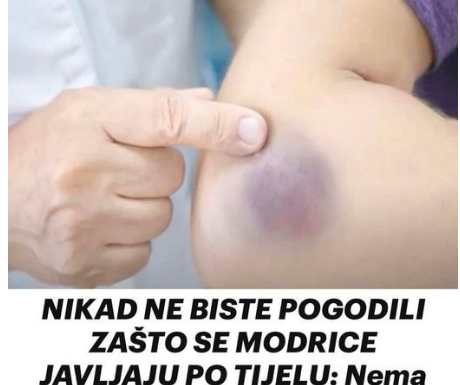Zašto se modrice pojavljuju bez vidljivog uzroka Evo šta stručnjaci kažu Zašto se modrice pojavljuju bez vidljivog uzroka Evo šta stručnjaci kažu