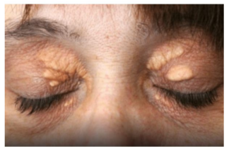 Ako vam se u blizini očiju pojavilo masno tkivo: Nipošto nemojte ga stiskati, morate učiniti sledeće da nestane! (Foto) Ako vam se u blizini očiju pojavilo masno tkivo: Nipošto nemojte ga stiskati, morate učiniti sledeće da nestane! (Foto)