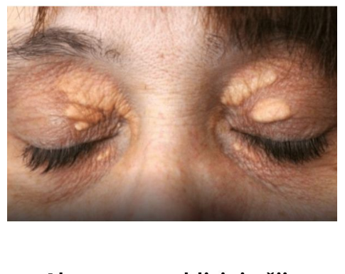 Ako vam se u blizini očiju pojavilo masno tkivo: Nipošto nemojte ga stiskati, morate učiniti sledeće da nestane! (Foto) Ako vam se u blizini očiju pojavilo masno tkivo: Nipošto nemojte ga stiskati, morate učiniti sledeće da nestane! (Foto)