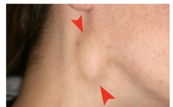 MALIGNE BOLESTI NIKADA NE ĆUTE: Ove signale bolest šalje telu, kada se u njemu razvijaju NAJOPASNIJI KARCINOMI! MALIGNE BOLESTI NIKADA NE ĆUTE: Ove signale bolest šalje telu, kada se u njemu razvijaju NAJOPASNIJI KARCINOMI!