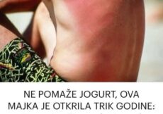 NE POMAŽE JOGURT, OVA MAJKA JE OTKRILA TRIK GODINE: Na ovaj način opekotine od sunca će nestati za POLA SATA