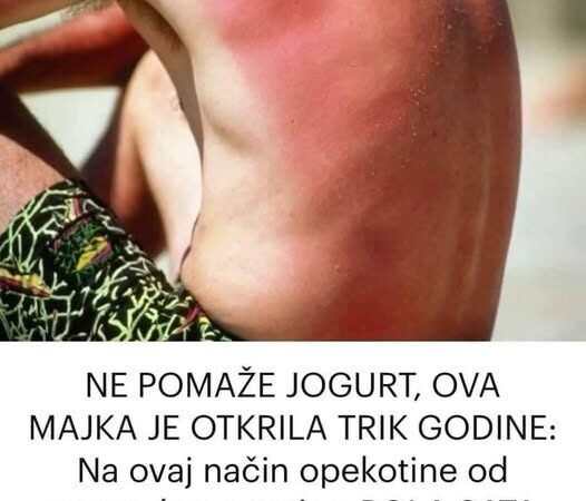 NE POMAŽE JOGURT, OVA MAJKA JE OTKRILA TRIK GODINE: Na ovaj način opekotine od sunca će nestati za POLA SATA