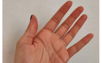 Osjećate li trnce u rukama ili prstima Ovaj simptom služi kao važan znak upozorenja koji se ne smije zanemariti Osjećate li trnce u rukama ili prstima Ovaj simptom služi kao važan znak upozorenja koji se ne smije zanemariti