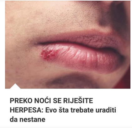 PREKO NOĆI SE RIJEŠITE HERPESA: Evo šta trebate uraditi da nestane