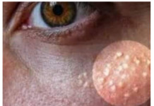 AK0 SU VAM SE P0JAVILE MALE BIJELE TAČKICE EVO NA KOJI NAČIN ĆETE IH SE RIJEŠITI AK0 SU VAM SE P0JAVILE MALE BIJELE TAČKICE EVO NA KOJI NAČIN ĆETE IH SE RIJEŠITI