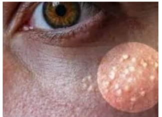 AK0 SU VAM SE P0JAVILE MALE BIJELE TAČKICE EVO NA KOJI NAČIN ĆETE IH SE RIJEŠITI AK0 SU VAM SE P0JAVILE MALE BIJELE TAČKICE EVO NA KOJI NAČIN ĆETE IH SE RIJEŠITI