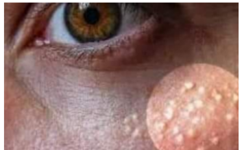 AK0 SU VAM SE P0JAVILE MALE BIJELE TAČKICE EVO NA KOJI NAČIN ĆETE IH SE RIJEŠITI AK0 SU VAM SE P0JAVILE MALE BIJELE TAČKICE EVO NA KOJI NAČIN ĆETE IH SE RIJEŠITI