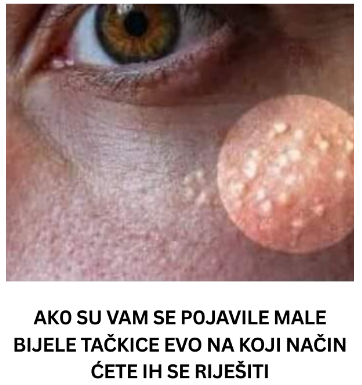 AK0 SU VAM SE P0JAVILE MALE BIJELE TAČKICE EVO NA KOJI NAČIN ĆETE IH SE RIJEŠITI AK0 SU VAM SE P0JAVILE MALE BIJELE TAČKICE EVO NA KOJI NAČIN ĆETE IH SE RIJEŠITI