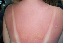 Opekotine od sunca nisu šala, evo kako vas mogu dovesti do melanoma: Ne ljuštite površinski sloj kože Opekotine od sunca nisu šala, evo kako vas mogu dovesti do melanoma: Ne ljuštite površinski sloj kože