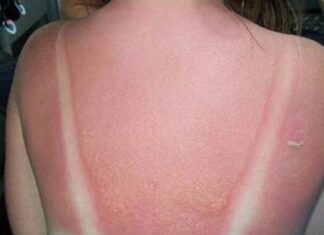 Opekotine od sunca nisu šala, evo kako vas mogu dovesti do melanoma: Ne ljuštite površinski sloj kože Opekotine od sunca nisu šala, evo kako vas mogu dovesti do melanoma: Ne ljuštite površinski sloj kože