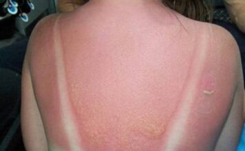 Opekotine od sunca nisu šala, evo kako vas mogu dovesti do melanoma: Ne ljuštite površinski sloj kože Opekotine od sunca nisu šala, evo kako vas mogu dovesti do melanoma: Ne ljuštite površinski sloj kože