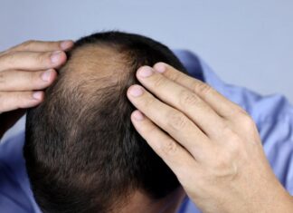 Zašto muškarci ostaju bez kose? Krivci nisu samo geni Zašto muškarci ostaju bez kose? Krivci nisu samo geni