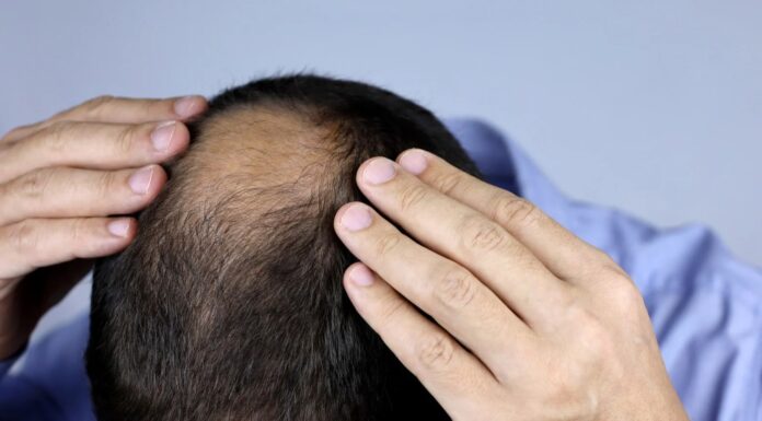 Zašto muškarci ostaju bez kose? Krivci nisu samo geni Zašto muškarci ostaju bez kose? Krivci nisu samo geni