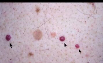 IMATE LI OVE CRVENE TAČKICE NA TIJELU? To nisu popucali kapilari, EVO O ČEMU SE ZAISTA RADI IMATE LI OVE CRVENE TAČKICE NA TIJELU? To nisu popucali kapilari, EVO O ČEMU SE ZAISTA RADI