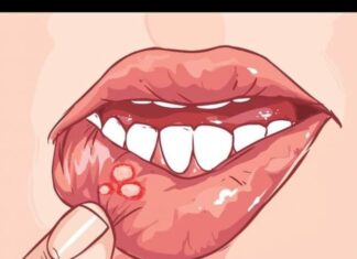 IMATE LI OVE RANICE U USTIMA? EVO NA ŠTA VAS ONE UPOZORAVAJU: Simptom koji ne smijete zanemariti IMATE LI OVE RANICE U USTIMA? EVO NA ŠTA VAS ONE UPOZORAVAJU: Simptom koji ne smijete zanemariti