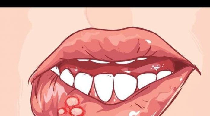 IMATE LI OVE RANICE U USTIMA? EVO NA ŠTA VAS ONE UPOZORAVAJU: Simptom koji ne smijete zanemariti IMATE LI OVE RANICE U USTIMA? EVO NA ŠTA VAS ONE UPOZORAVAJU: Simptom koji ne smijete zanemariti