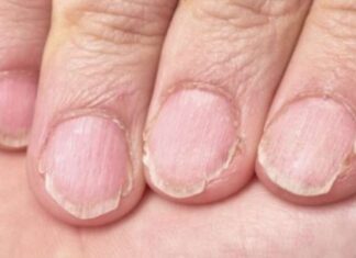 MUČE VAS UMOR, TANKA KOSA I LOMLJIVI NOKTI, EVO ŠTA VAM NEDOSTAJE U ISHRANI MUČE VAS UMOR, TANKA KOSA I LOMLJIVI NOKTI, EVO ŠTA VAM NEDOSTAJE U ISHRANI