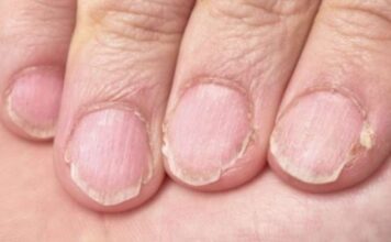 MUČE VAS UMOR, TANKA KOSA I LOMLJIVI NOKTI, EVO ŠTA VAM NEDOSTAJE U ISHRANI MUČE VAS UMOR, TANKA KOSA I LOMLJIVI NOKTI, EVO ŠTA VAM NEDOSTAJE U ISHRANI