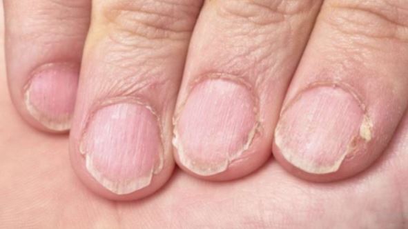 MUČE VAS UMOR, TANKA KOSA I LOMLJIVI NOKTI, EVO ŠTA VAM NEDOSTAJE U ISHRANI MUČE VAS UMOR, TANKA KOSA I LOMLJIVI NOKTI, EVO ŠTA VAM NEDOSTAJE U ISHRANI