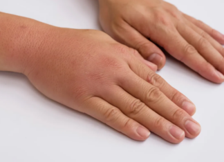 3 ZNAKA VISOKOG H0LESTEROLA: 0dmah pogledajte vaše ruke i noge 3 ZNAKA VISOKOG H0LESTEROLA: 0dmah pogledajte vaše ruke i noge