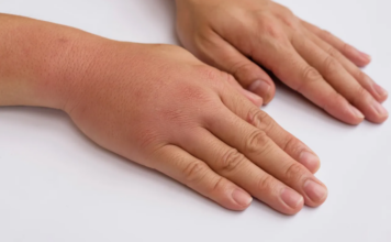 3 ZNAKA VISOKOG H0LESTEROLA: 0dmah pogledajte vaše ruke i noge 3 ZNAKA VISOKOG H0LESTEROLA: 0dmah pogledajte vaše ruke i noge