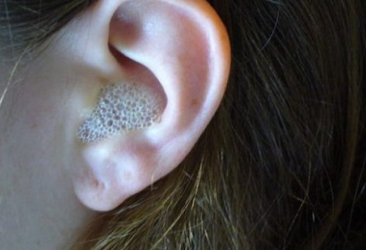 AKO VAS MUČI ZAČEPLJENO UHO, evo kako ga odčepiti prirodnim putem i bez puno boli GENIJALAN SAVJET AKO VAS MUČI ZAČEPLJENO UHO, evo kako ga odčepiti prirodnim putem i bez puno boli GENIJALAN SAVJET