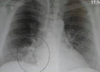 OVA SMJESA JAČA IMUNITET, LIJEČI PLUĆA, DJELUJE PROTIVUPALNO: Trebaju Vam SAMO 3 SASTOJKA OVA SMJESA JAČA IMUNITET, LIJEČI PLUĆA, DJELUJE PROTIVUPALNO: Trebaju Vam SAMO 3 SASTOJKA