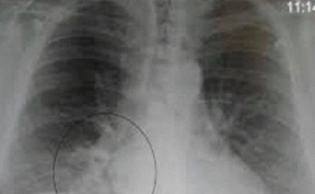 OVA SMJESA JAČA IMUNITET, LIJEČI PLUĆA, DJELUJE PROTIVUPALNO: Trebaju Vam SAMO 3 SASTOJKA OVA SMJESA JAČA IMUNITET, LIJEČI PLUĆA, DJELUJE PROTIVUPALNO: Trebaju Vam SAMO 3 SASTOJKA