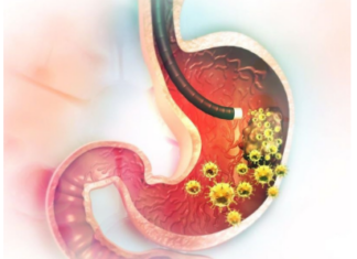 5 ranih simptoma raka želuca: Tumor može da raste godinama, a svi pacijenti prvo osjete ovo 5 ranih simptoma raka želuca: Tumor može da raste godinama, a svi pacijenti prvo osjete ovo