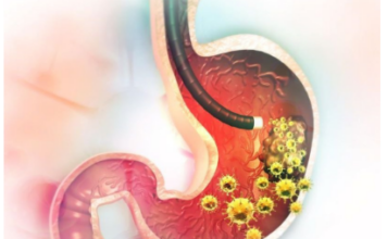 5 ranih simptoma raka želuca: Tumor može da raste godinama, a svi pacijenti prvo osjete ovo 5 ranih simptoma raka želuca: Tumor može da raste godinama, a svi pacijenti prvo osjete ovo